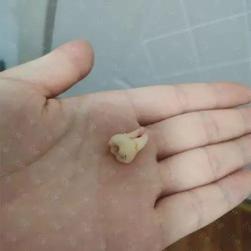 智齿长什么样子图片 智齿是长在哪个位置的图片