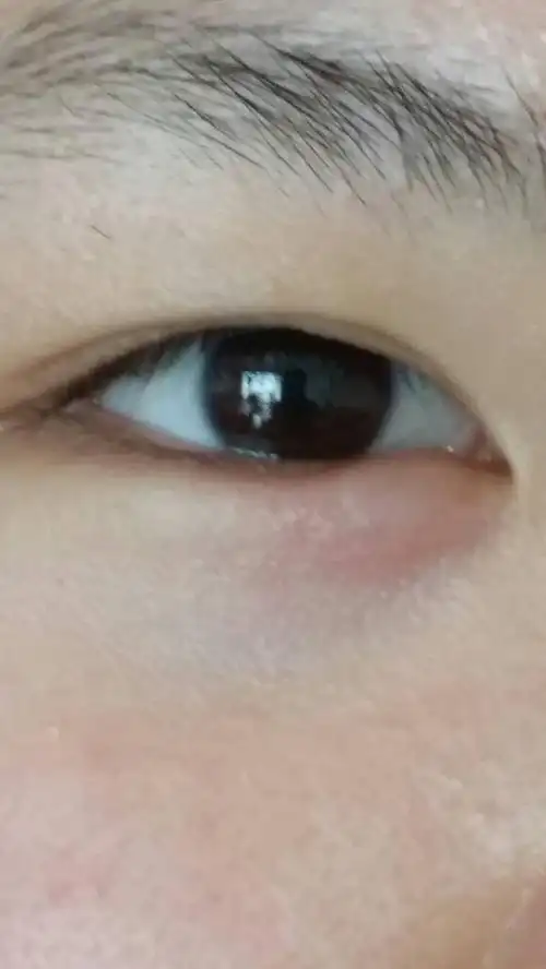 眼角起了个水泡,就半小时的功夫,这怎么让它下去啊~谁知道什么病?
