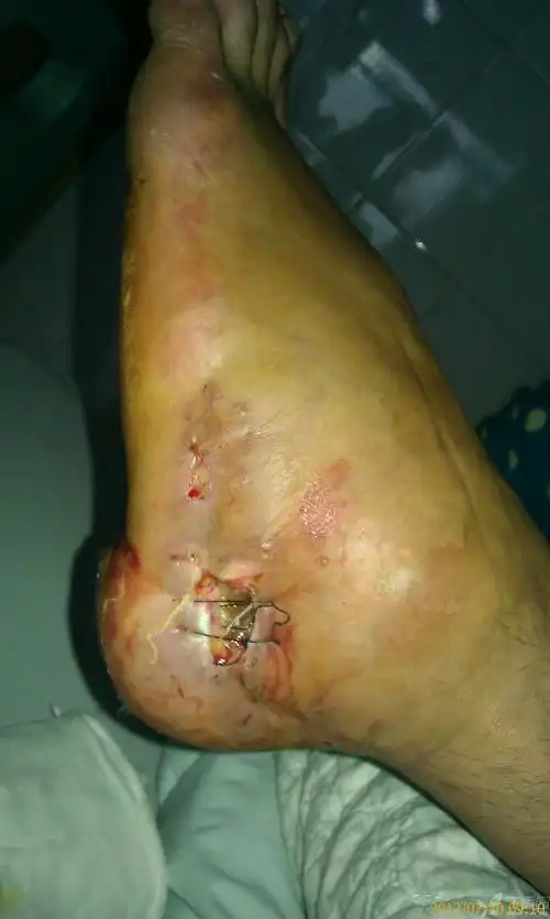 跟骨骨折术后皮肤坏死