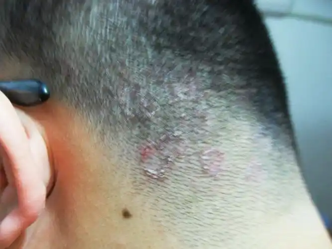 后脑勺长红点,热了就痒,请问怎么处理?