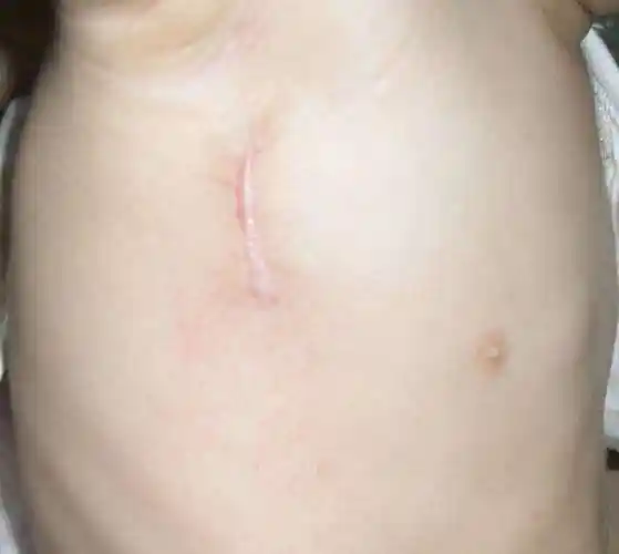 胸骨下端小切口