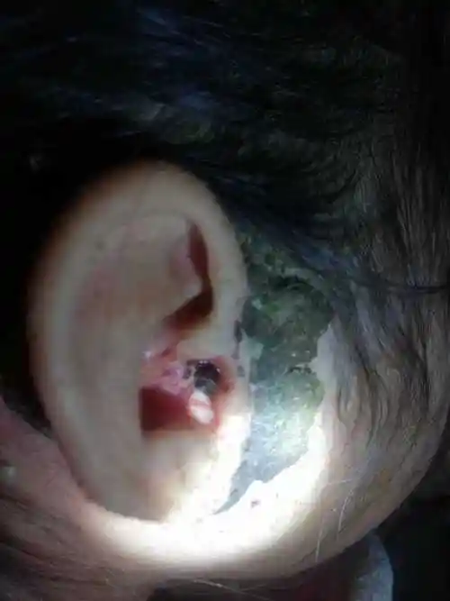 问止中医|程思雅医师:治中耳炎一例,喝药后耳朵掉出腐肉