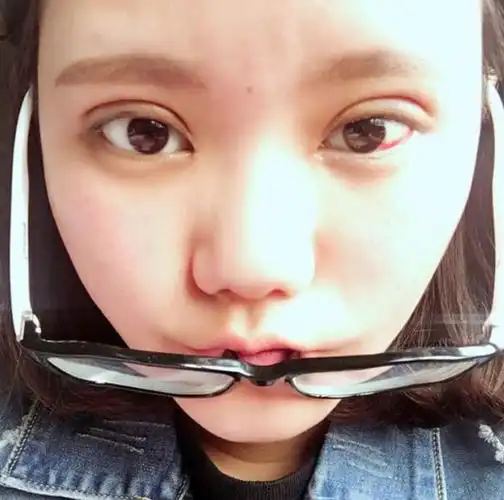 6mm平行双眼皮案例分享