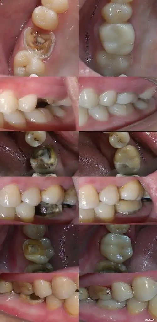 【经验交流】复合树脂高嵌体