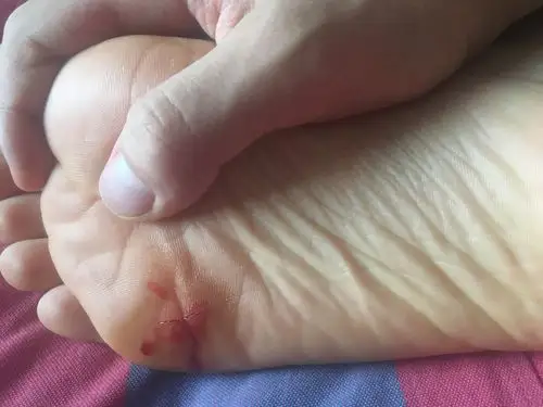 脚丫子出血了咋处理