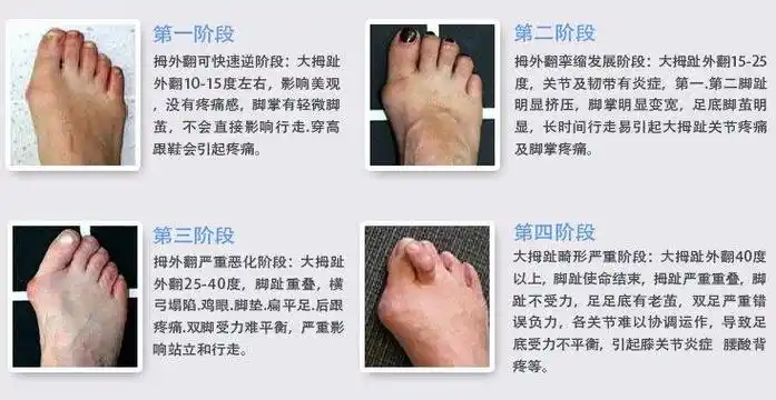 拇外翻,看这一篇就够了!