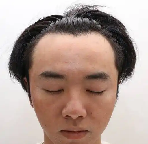 网友称华晨宇是自己老公,还晒出多张华晨宇植发照片,称张碧晨是小三