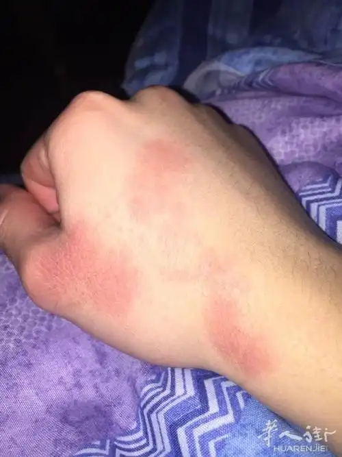 手背过敏好几个月了
