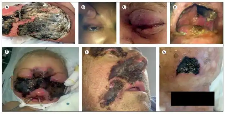 没有进行治疗和病情控制的糖尿病患者,起病6天,出现皮肤红斑,上睑下垂