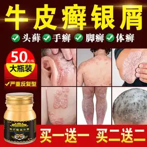 牛皮癣银屑病药膏止痒抑菌治疗皮肤外用瘙痒头藓股体癣湿疹特效药