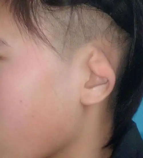 左侧中度杯状耳耳廓周缘长度不足,明显紧缩,耳轮,耳舟,对耳轮等结构