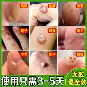 治瘊子鱼鳞痣贴祛刺猴去除正品去手上猴子肉粒疙瘩脚上肉刺去除膏