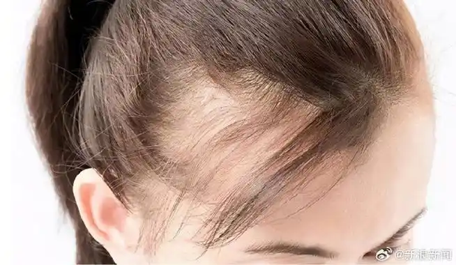 会不会导致脱发?