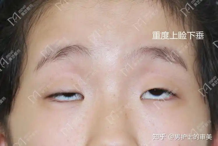 如何判断是否是上眼皮肌无力