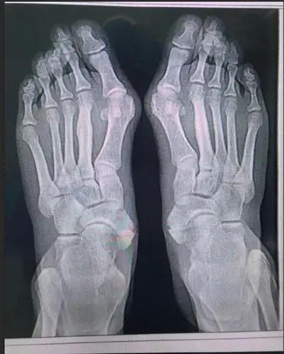 做完大脚骨多长时间走路