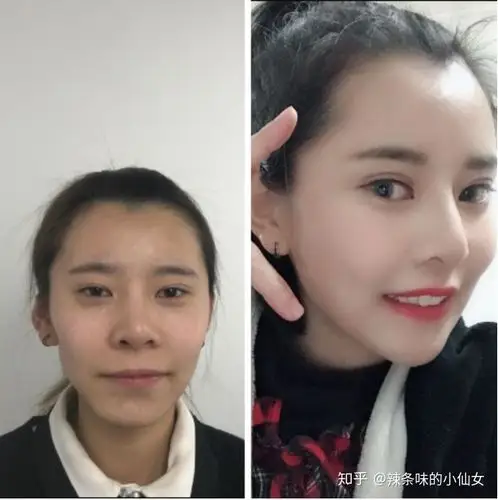 自体脂肪填充需要做几次呢,填充太阳穴?