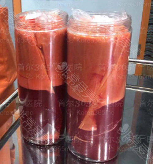 365mc医院抽取出的脂肪