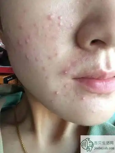 脸上长痘痘怎么调理祛痘护肤小妙招轻松拒绝痘痘肌肤