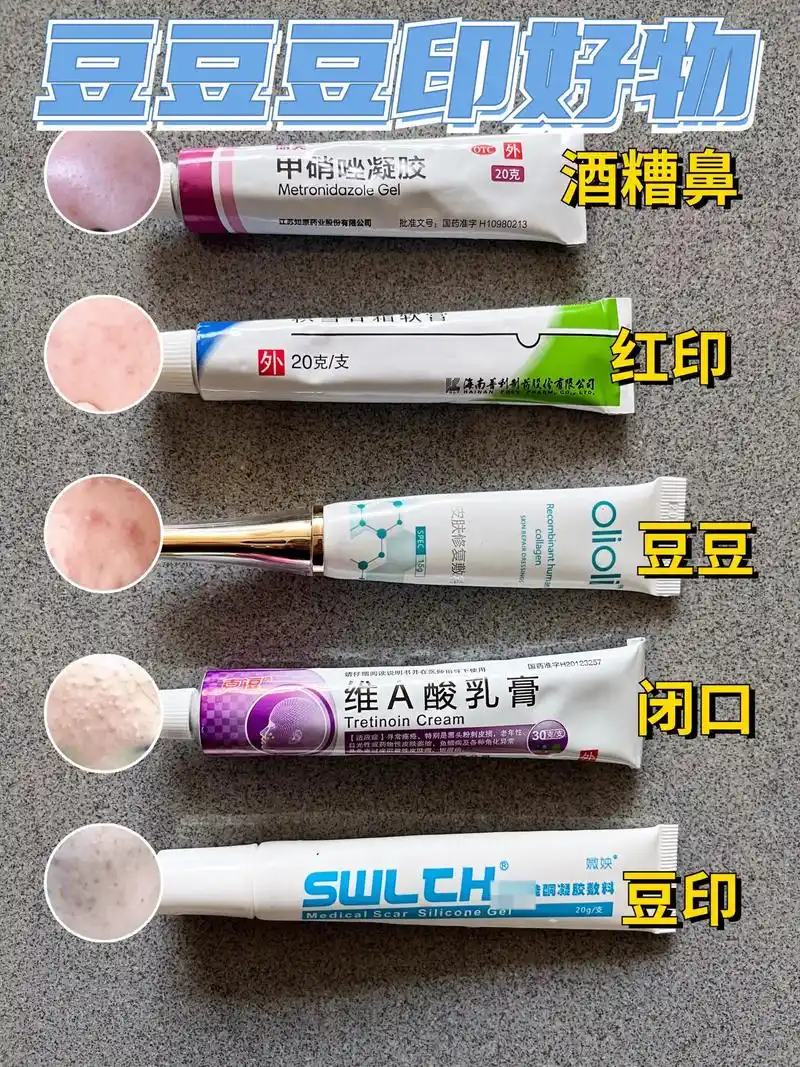 祛痘药膏丨皮肤科推荐.