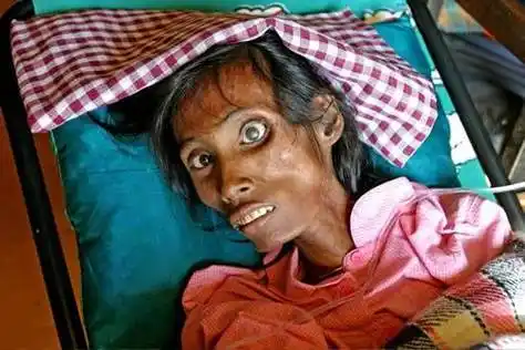 艾滋病口腔症状是怎样的