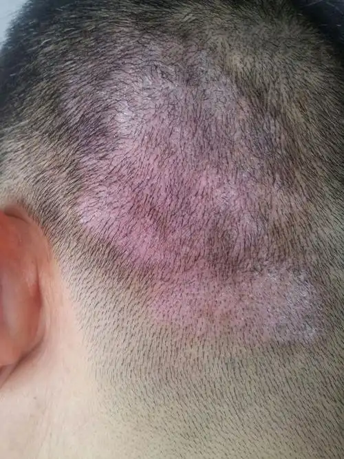 求助头上一片红这是什么皮肤病