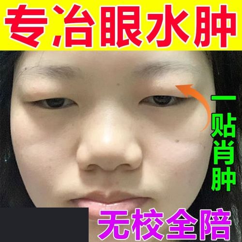 消除眼睛去水肿眼泡浮肿红肿痛肿胀眼睑上眼皮过敏眼部神器消脂贴