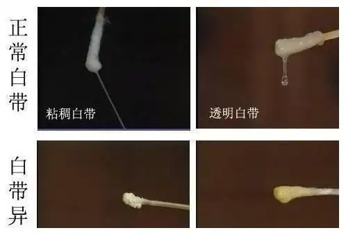 女性同志要长点心阴道分泌物呈这6种颜色就不能再同房了