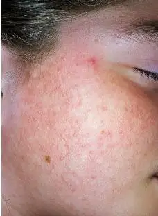 湿疹(特应性皮炎)什么样的一个疾病?