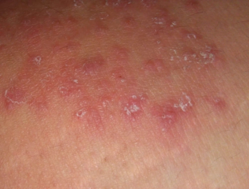 体股癣初期现象图片8