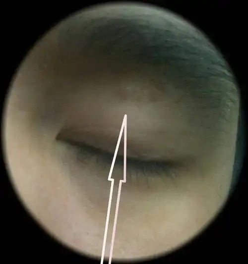 眼睛上长了颗类似痘痘的东西,但又不痒不痛也不红,捏起来圆圆的不痛.