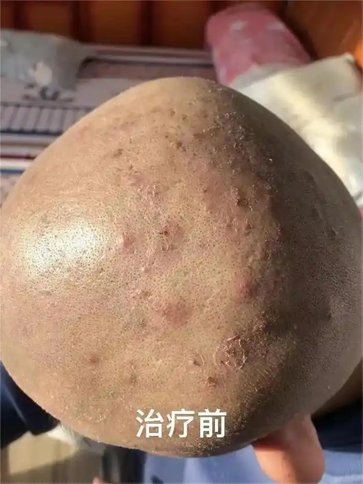 头皮上长痘痘红肿痒痛这是怎么回事