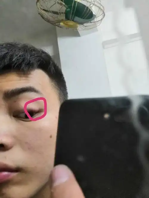 以前眼睛眼皮下面这里一直有个包一样 看不出来用手摸能感觉的到是一