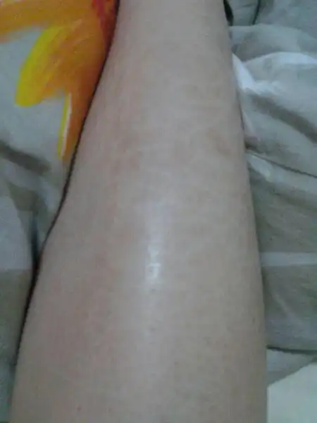 长这种鱼鳞状东西该怎么办