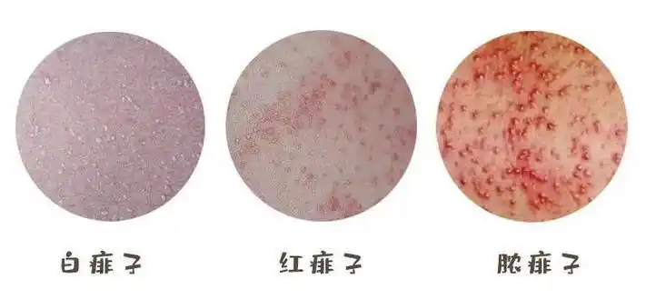 一张图教你区别湿疹和痱子,从部位/症状/时间区分(湿疹时间长)