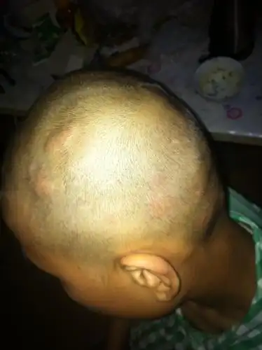 小孩头上突然长很多苞,又大又多.是怎么回事? 没有其他症状,偶尔会痒.