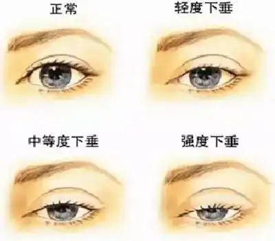 你真的是上睑下垂吗?