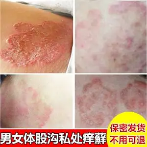 屁眼屁股两边痒专用癣药大腿内侧外阴皮肤藓阴囊铜钱癣蛋蛋止痒膏
