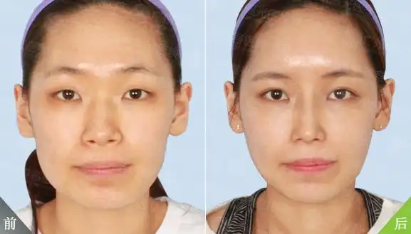 大学生全面部整形术前术后对比(组图)