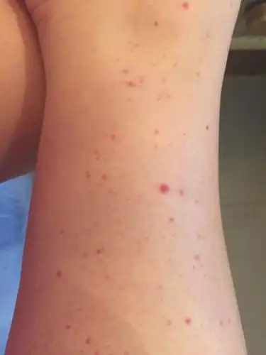 腿上长这种小红点是怎么会事.是不是体内湿气太重引起的.