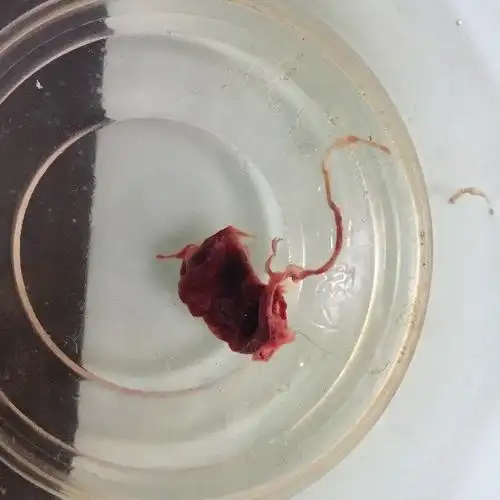 药流第二天流出来的 这是孕囊吗 这是已经流干净了吗