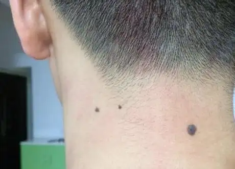 1,脖子后面有痣说明你很有远大的理想很美好的憧憬,但是苦无门路和