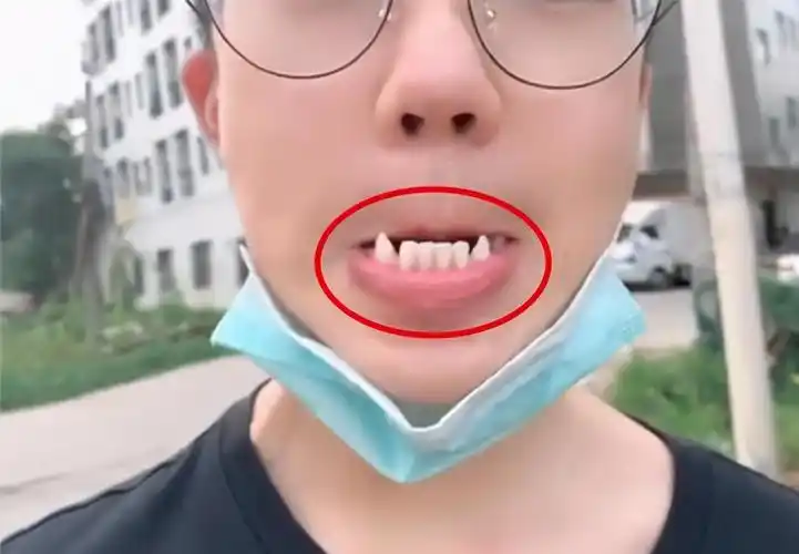 原创17岁儿子长尖牙亲妈吐槽像吸血鬼网友也可能是个狼人