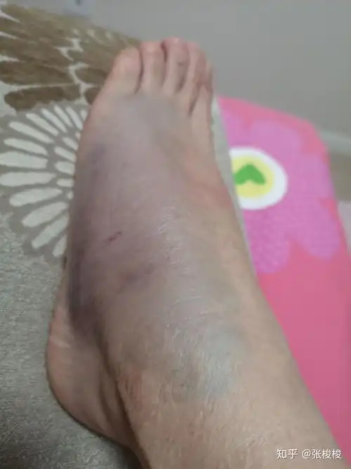 骨折记录第二天