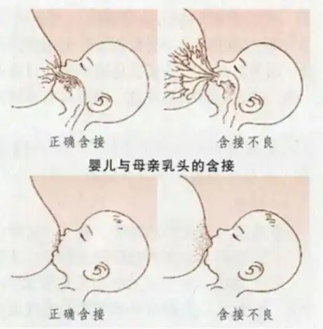 老婆生娃第三天,乳头被吸得很痛且皲裂了,苦不堪言,如何是好?