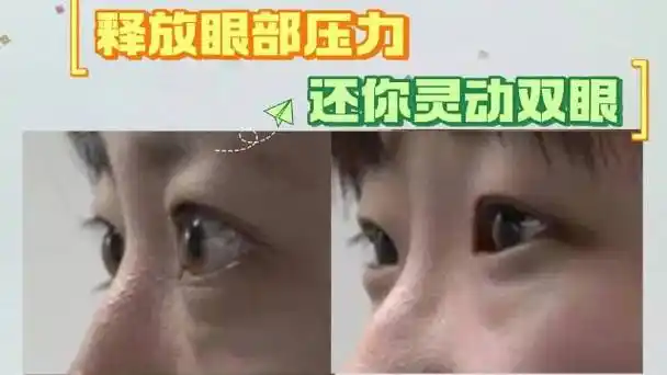 近视导致眼球突出##眼球突出##突眼矫正##眼球突出并非因为长拼戴