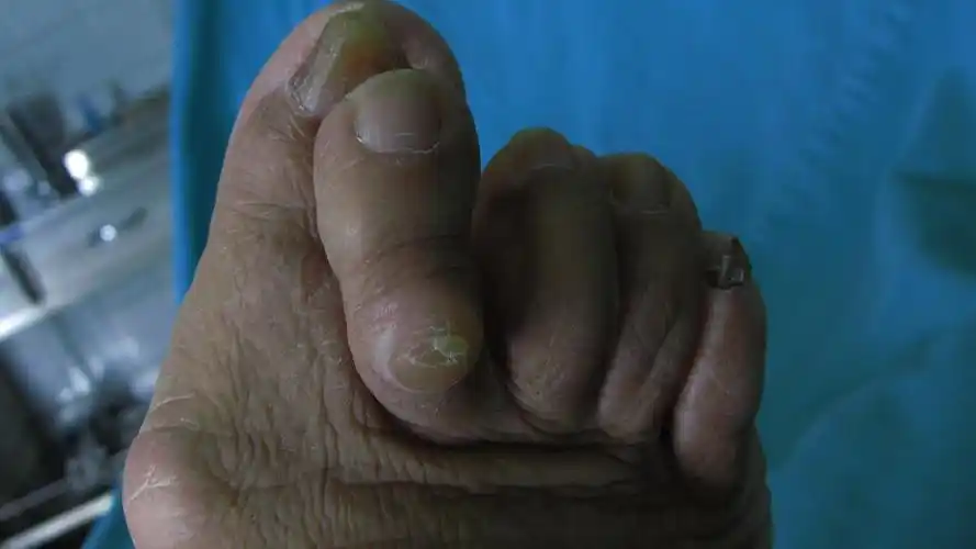 踇外翻叠趾畸形 术前术后 对照图 - 好大夫在线