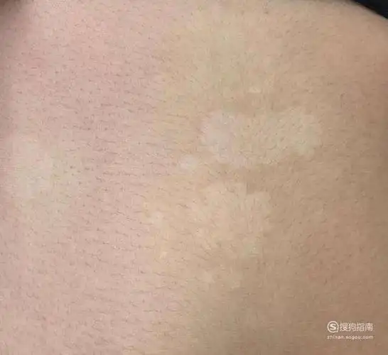 一同白斑的外形主要为圆形或者卵形,指甲盖大小,在早期可以会以点状的