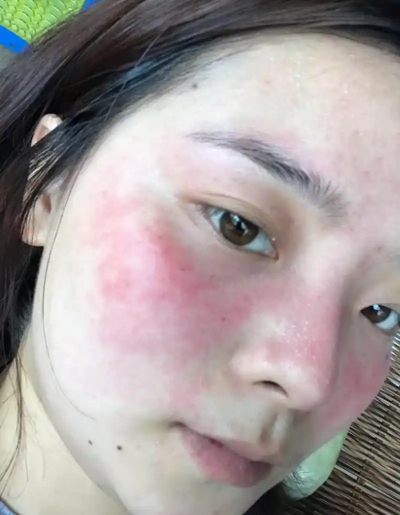 脸部角质层薄如何增厚#医美科普挑战赛#   脸部角质层的健康与皮肤的