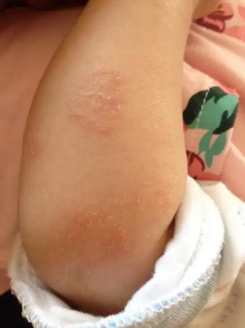 从你的描述来看应该是皮癣,是由于真菌皮霉菌引起的一种传染性皮肤病