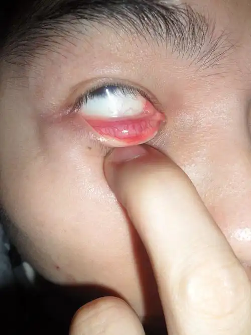 我的下眼皮里面长了个东西不知道是不是肿瘤 硬硬的